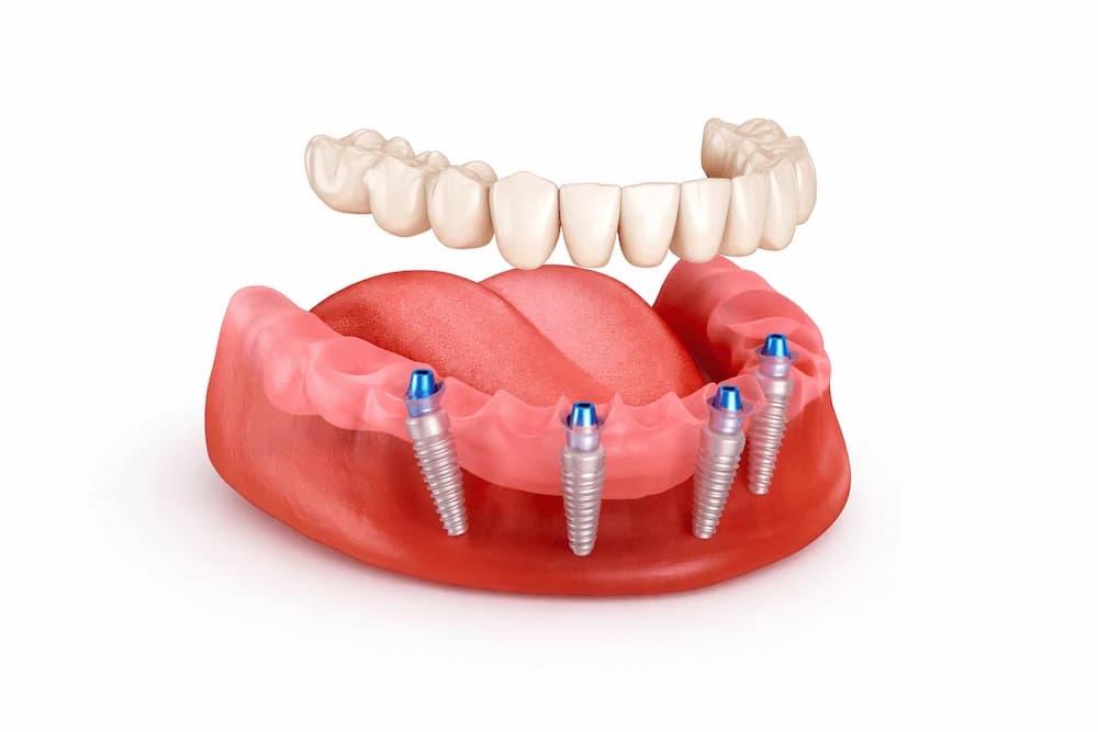 All-on-4 Implants