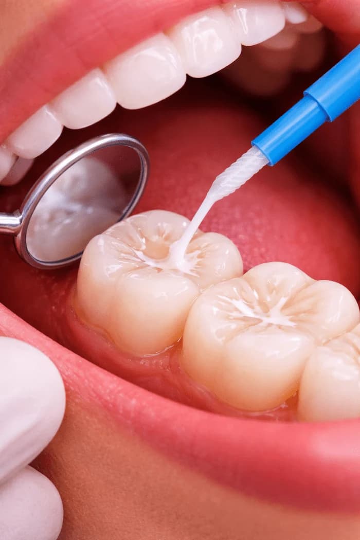 Dental Sealants
