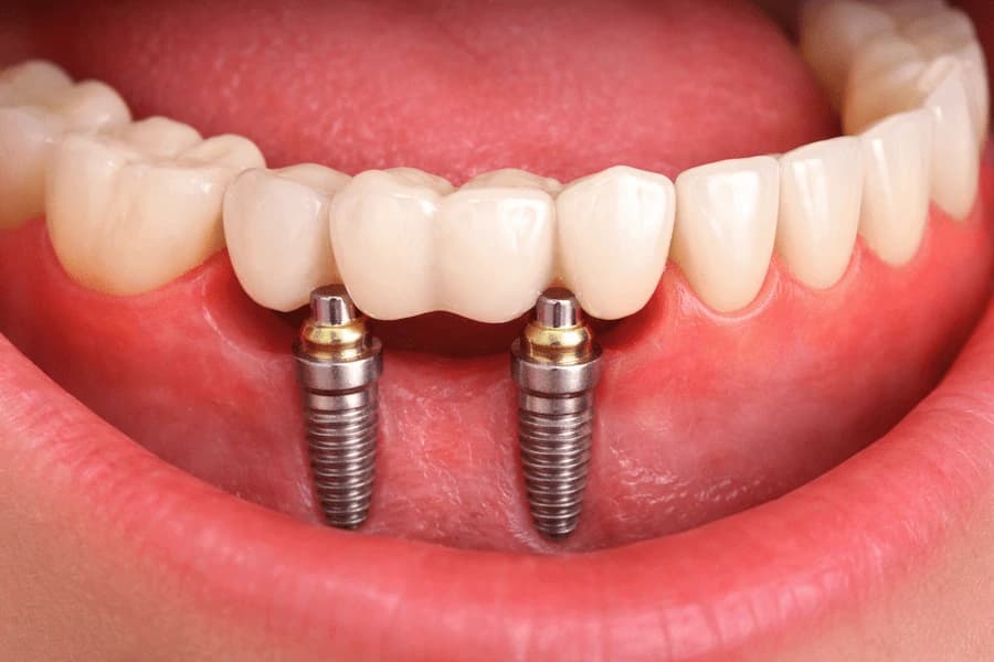 Implant-Supported Bridges