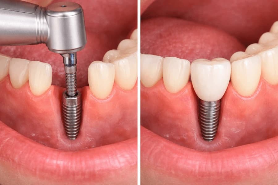 Same-Day Dental Implants