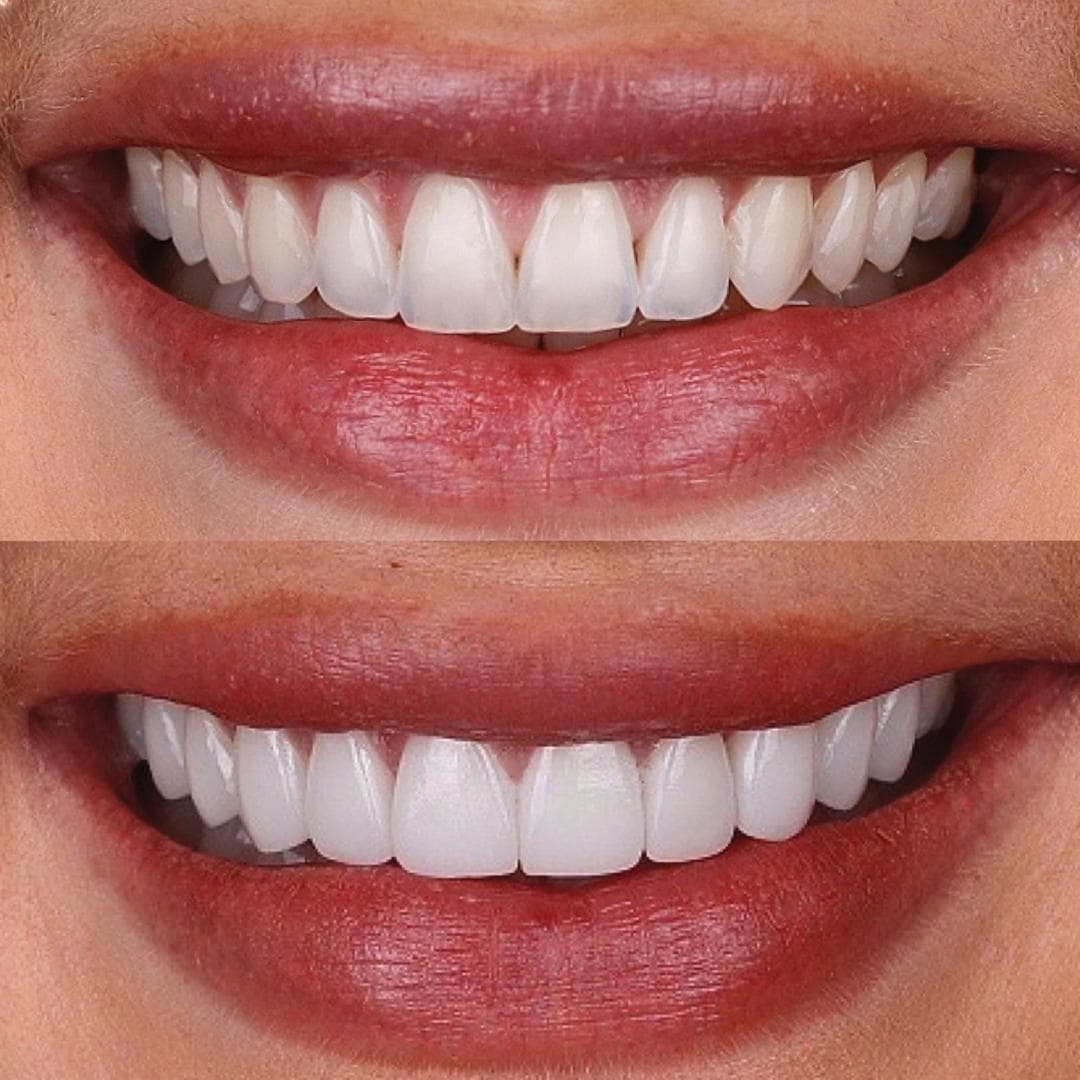 Porcelain Veneers
