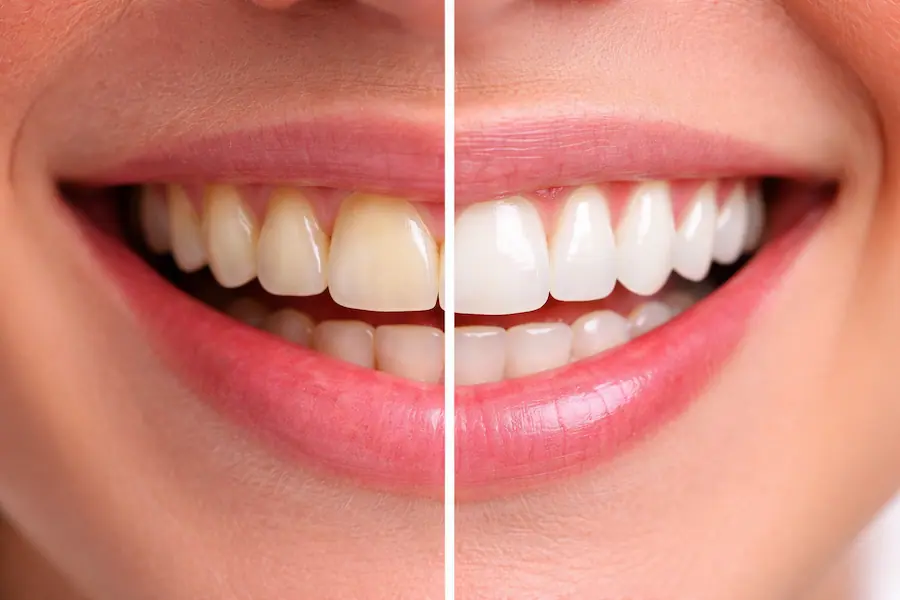 Teeth Whitening