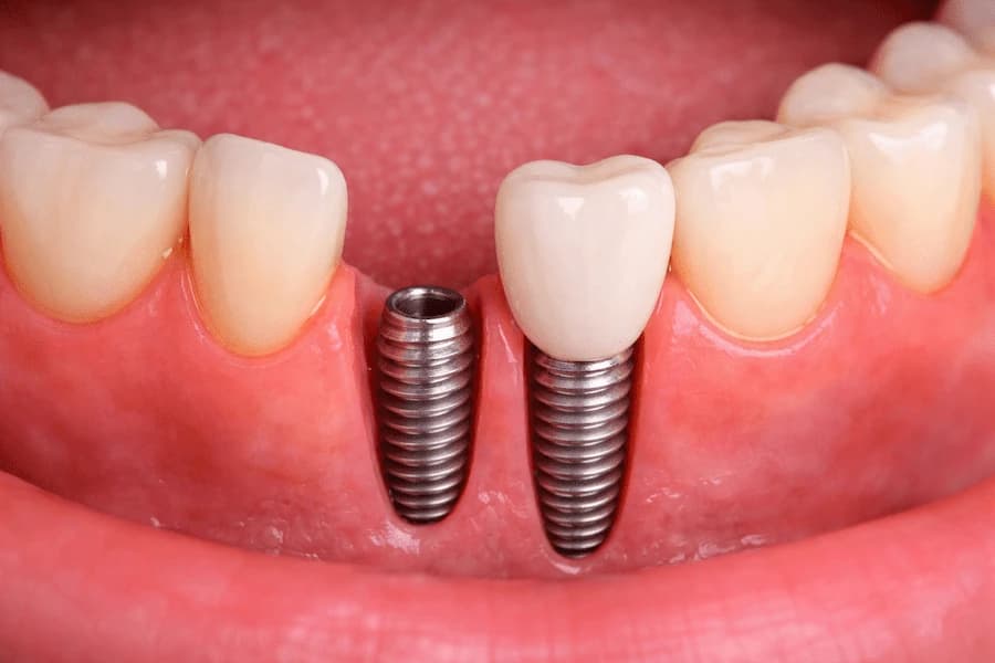 Dental Implants
