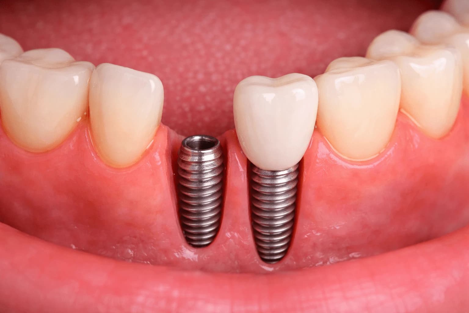 Dental Implants